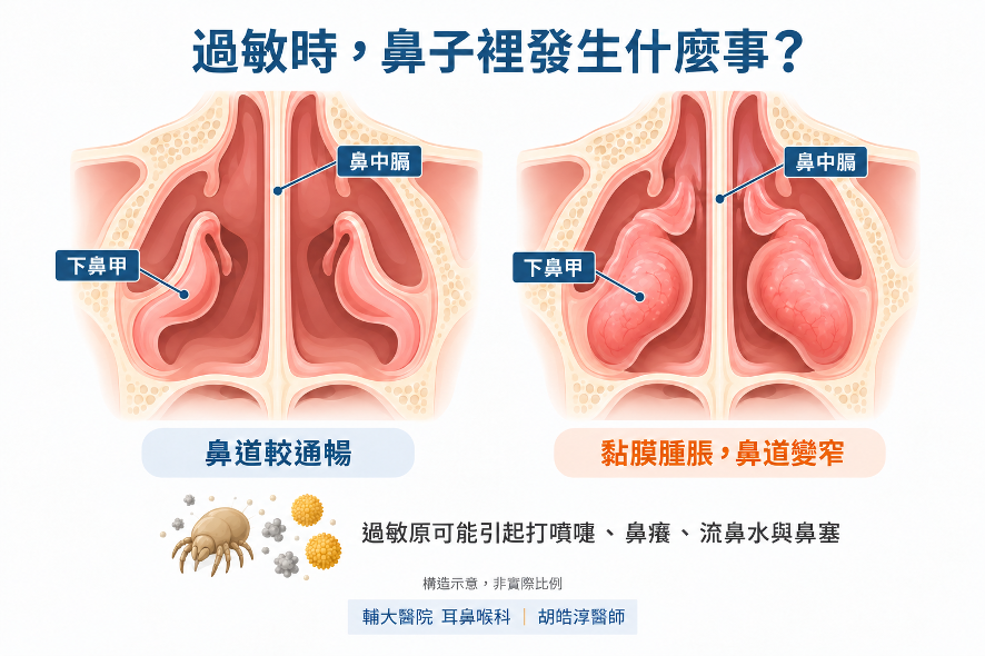 過敏反應可能讓鼻黏膜腫脹、下鼻甲變大,使鼻道變窄