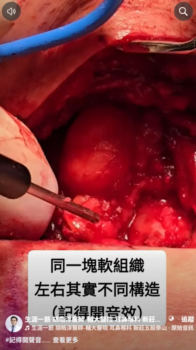 甲狀腺手術